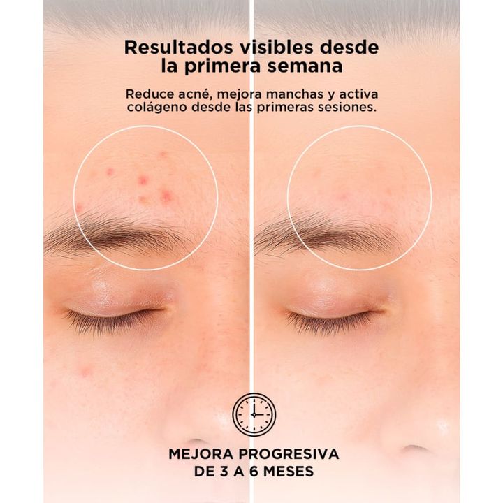 Mascara Facial Led Gadnic LT3.0 Terapia Acné Rejuvenecimiento - Vista 3
